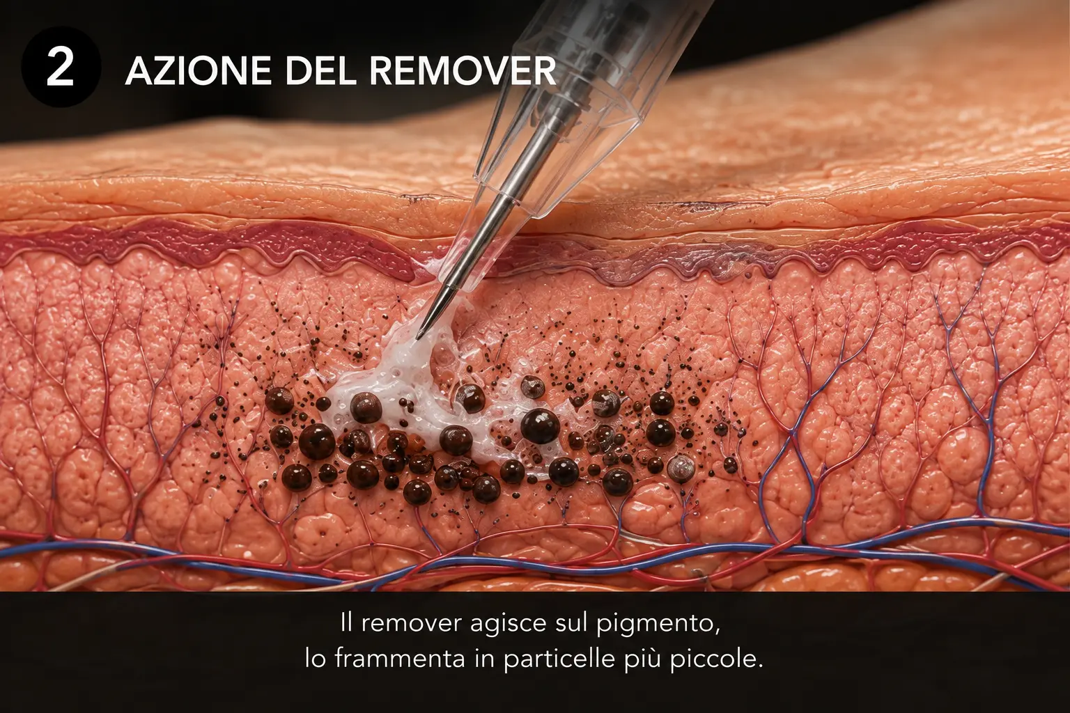 Azione del remover